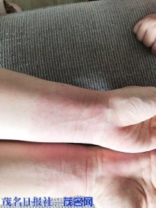 长时间带防疫橡胶手套导致过敏。<br>
